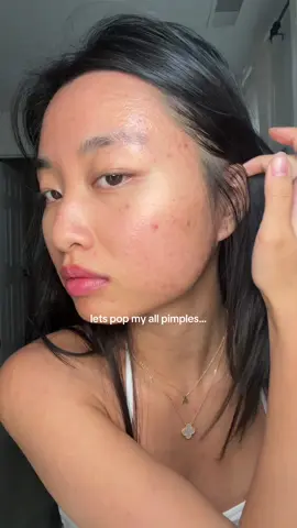 a new day means a new pimple to pop🥲 #acne #pimples #acneproneskin #acnejourney 
