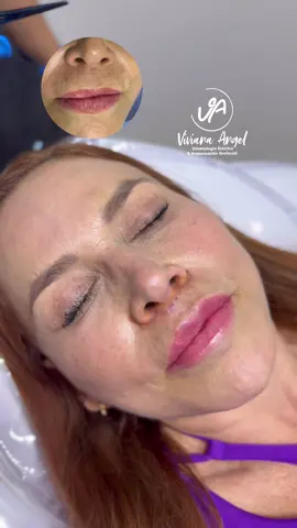 Logramos elevar el labio superior extirpando una pequeña zona de piel situada por debajo de la nariz.  🫦