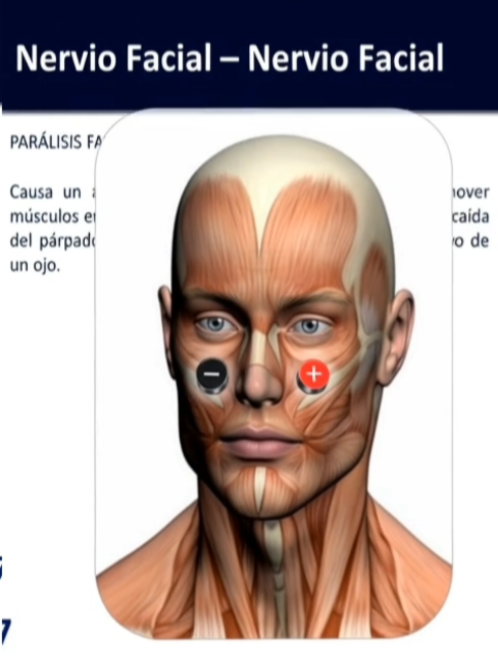 @BIOMAGNETISMOADISTANCIA🩵 Te dijeron que la cara se te cayó por ‘un aire’… pero aquí está la parte incómoda: eso no es verdad. Y lo que realmente está pasando… casi nadie quiere tocarlo. MIRA AL FINAL Y COMPARTE TALVEZ alguien que quieres está SUFRIENDO . A veces una sola información cambia un día completo. El rostro no se cae por supersticiones.  Porque si un nervio pierde estabilidad, el músculo se desconecta. Si el músculo se desconecta, la cara cambia. Y si nadie corrige el origen, el tiempo lo complica. Aquí viene lo que pocos aceptan del biomagnetismo: si regulas el campo eléctrico del nervio, el rostro cambia de regreso. Coloca el Par Nervio Facial – Nervio Facial así: • Negativo (negro –) en el lado derecho. • Positivo (rojo +) en el lado izquierdo  25 minutos. Respira. Visualiza cómo tu rostro recupera volumen y fuerza desde adentro. Sigue siempre tu tratamiento médico. Los imanes son tu terapia de relax… sorprende a tu médico cuando vea tus estudios y tu bienestar.  Si conoces a alguien que lleva meses con parálisis facial y solo le dijeron ‘aguántate’… mándale este video. Para que TikTok no lo esconda: Comparte, Guarda, comenta ‘rostro’, y da Like. Entra a mi perfil y aprende más de Biomagnetismo  #terapiaimanes #biomagnetismo #desintoxicatucuerpo #terapiaconimanes #paralisisfacial 