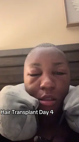 Day 4  Hair transplant swelling  #hairtransplant #hairtransplantturkey 