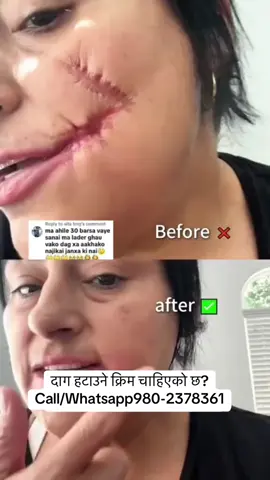 #stitch #stretchmarks #viral #viralvideo #scar 