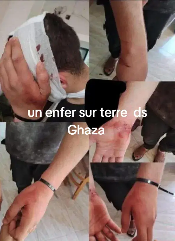 Signes d'une attaque brutale par des soldats israéliens sur un jeune Palestinien détenu lors de leur incursion militaire sur le village d'Urif, situé au sud de Naplouse.#réllier  la censure veulent normalisé cette atrocités inhumaine 