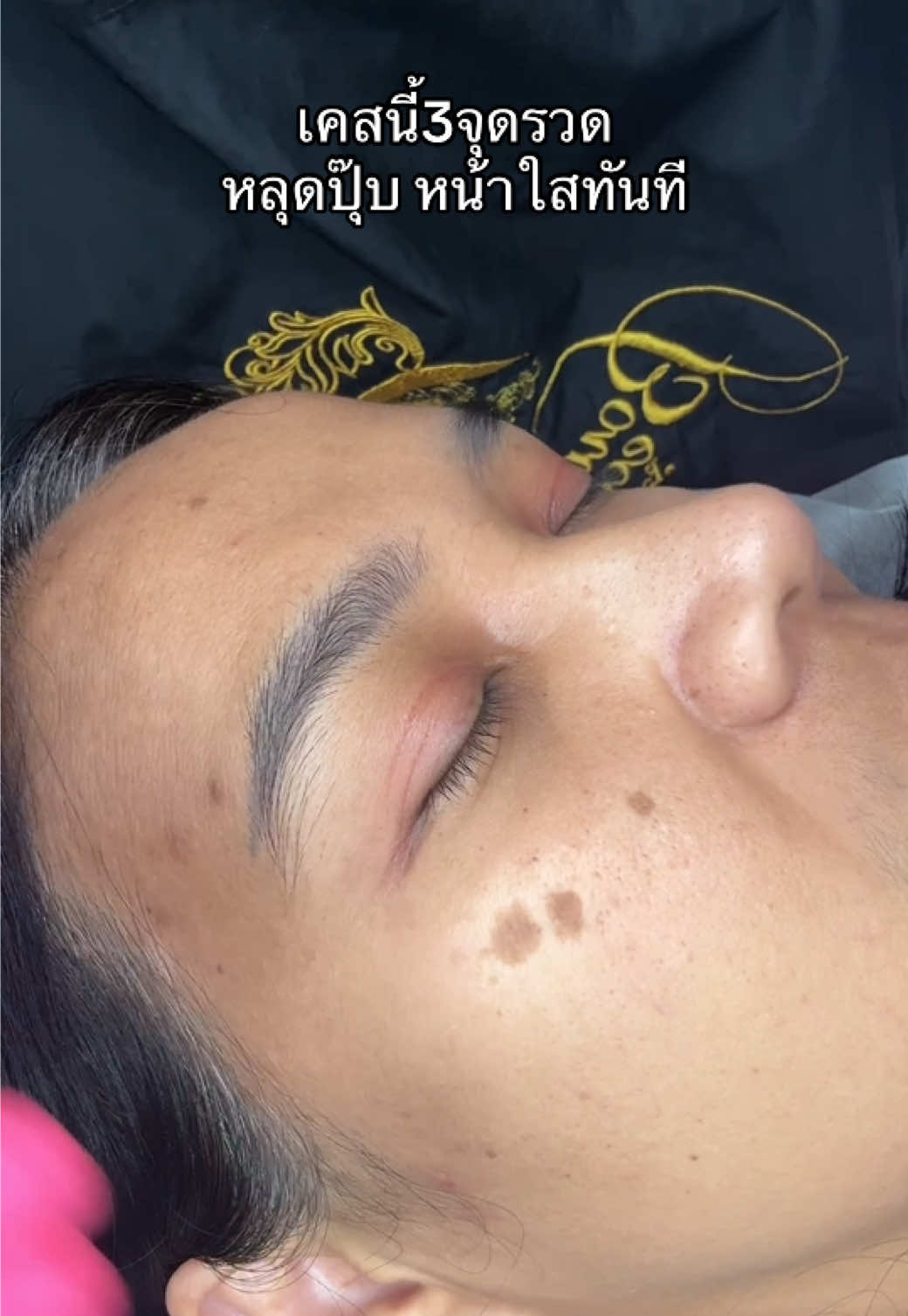 ลูกค้าบอกว่ายังไม่ทันได้เจ็บเลยเสร็จแล้วหรอ🤣 #จี้กระ #จี้กระแดด #จี้ติ่งเนื้อ #จี้ไฝ  #creatorsearchinsights  จองคิว 📱087-6732830 Line 🆔 : @bowbeauty พิกัดร้าน 🏠: บ้านกลางเมืองโชคชัย4ซอย50 ลาดพร้าว กทม. 🕙เปิดทำการ : 10.00-18.00น. ปิดทุกวันอาทิตย์