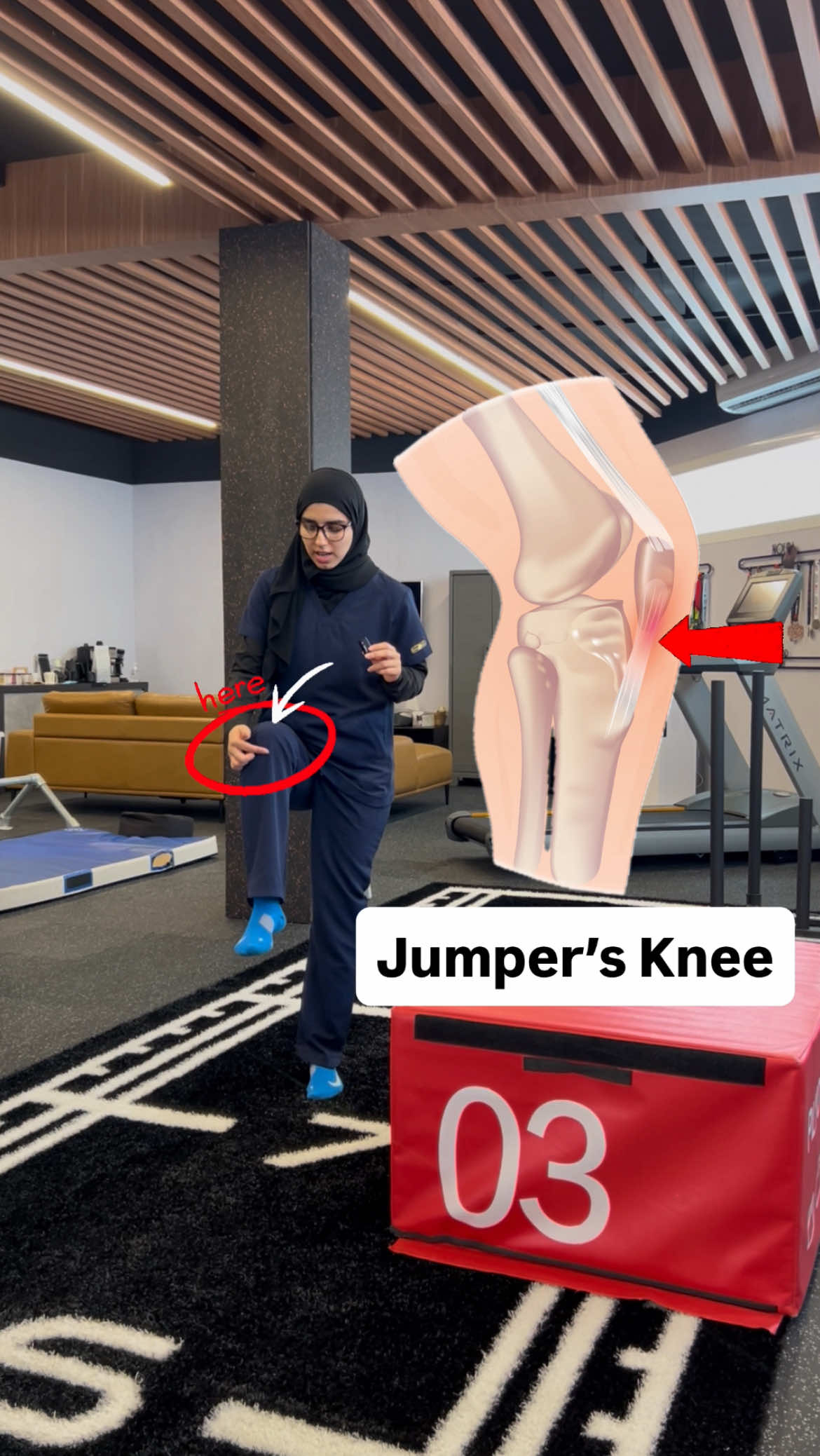 ⁨	⁨	⁨	ركبة القافز هي ألم تحت صابونة الركبة بسبب تكرار القفز أو تمارين مثل السكوات والجمب، وغالبًا ينتج عن التهاب في الوتر. يخفّ مع الراحة، تمارين تقوية خفيفة، وتمطيط مناسب. ‎إذا كان صعب عليكم الثبات لمدة 45 ثانية، ابدأوا التمرين بـ 15 ثانية ثبات و 3 تكرارات. اهم شي تسوون التمارين و الالم اقل من  5/10  JumpersKnee #PatellarTendinopathy #KneePain #RehabExercise #SportsInjury #ركبة_القافز    ⁩⁩⁩