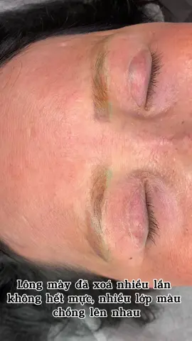 Hút mực chân mày bằng Laser CO2 tại Mỹ Tho #LaserCO2fractional #mytho #hutmucphunxam #lasertattooremoval  