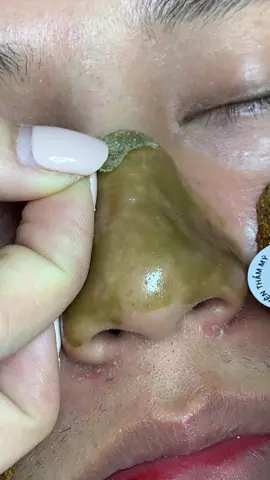 Xíu đi #chamsocdamun#chamsocdaseo#chamsocdanam#tanbinh#Lqspa&academy