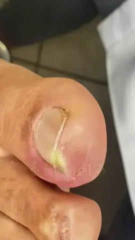 #nails #unhaencravada #ingrowntoenail #podologia #fyy 