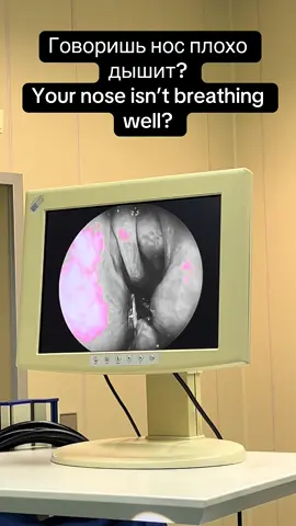 Если вам нужна консультация или операция, пишите в личку #dradiyer #детскийлорастана #лорастана #рек #аденоиды 