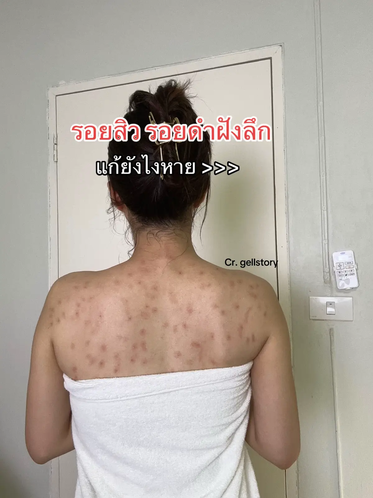 เคล็ดลับหลังสวย ลดรอยดำฝังลึก ผิวคล้ำเสีย #เธรด #ฟีดดดシ #fypシ #รีวิวบิวตี้