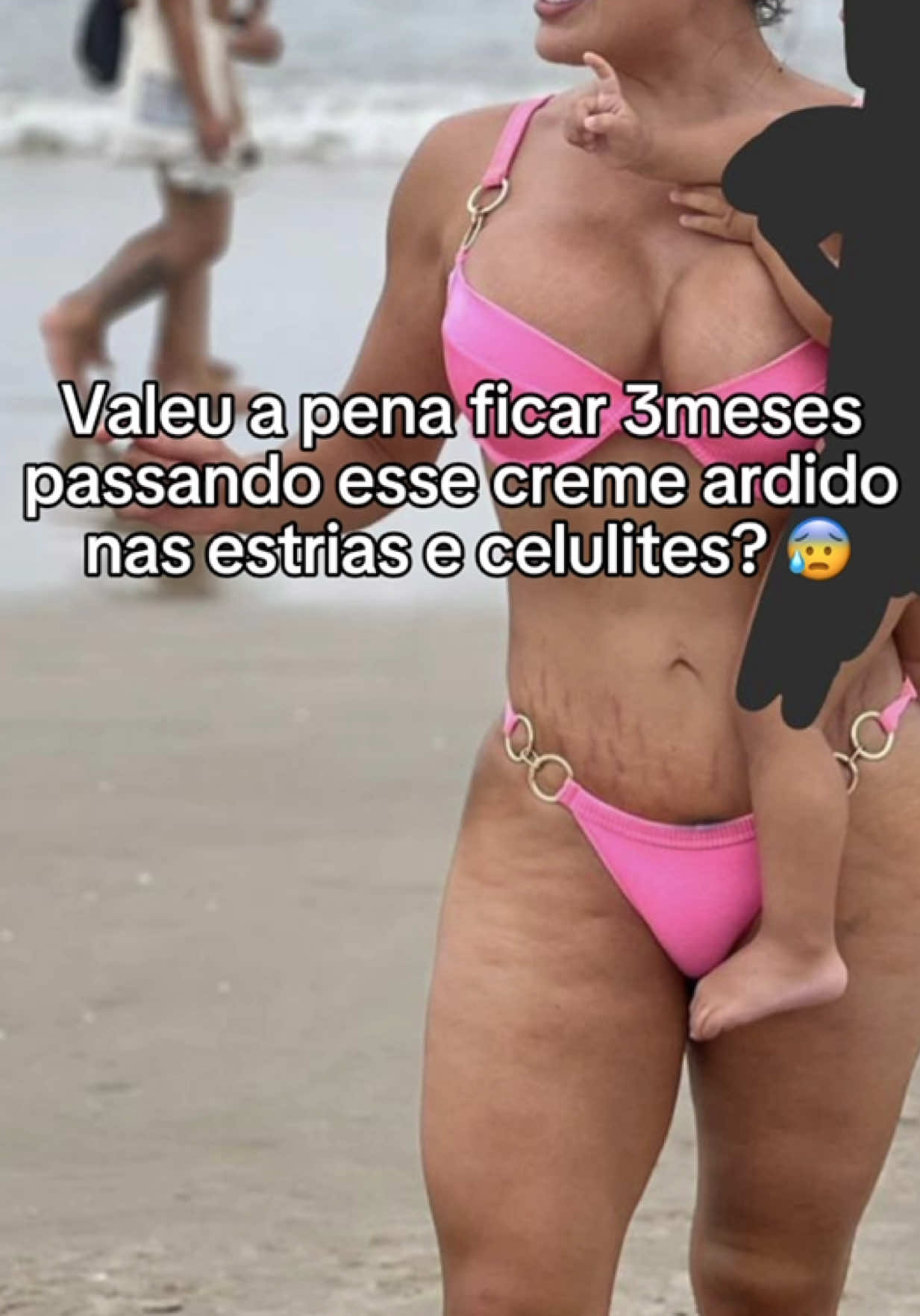 Consegui amigaaaas.. sou uma nova mulher, sem estrias e sem celulites. #estrias #estriasbrancas #estriasgestacao #celulite #lipedema 