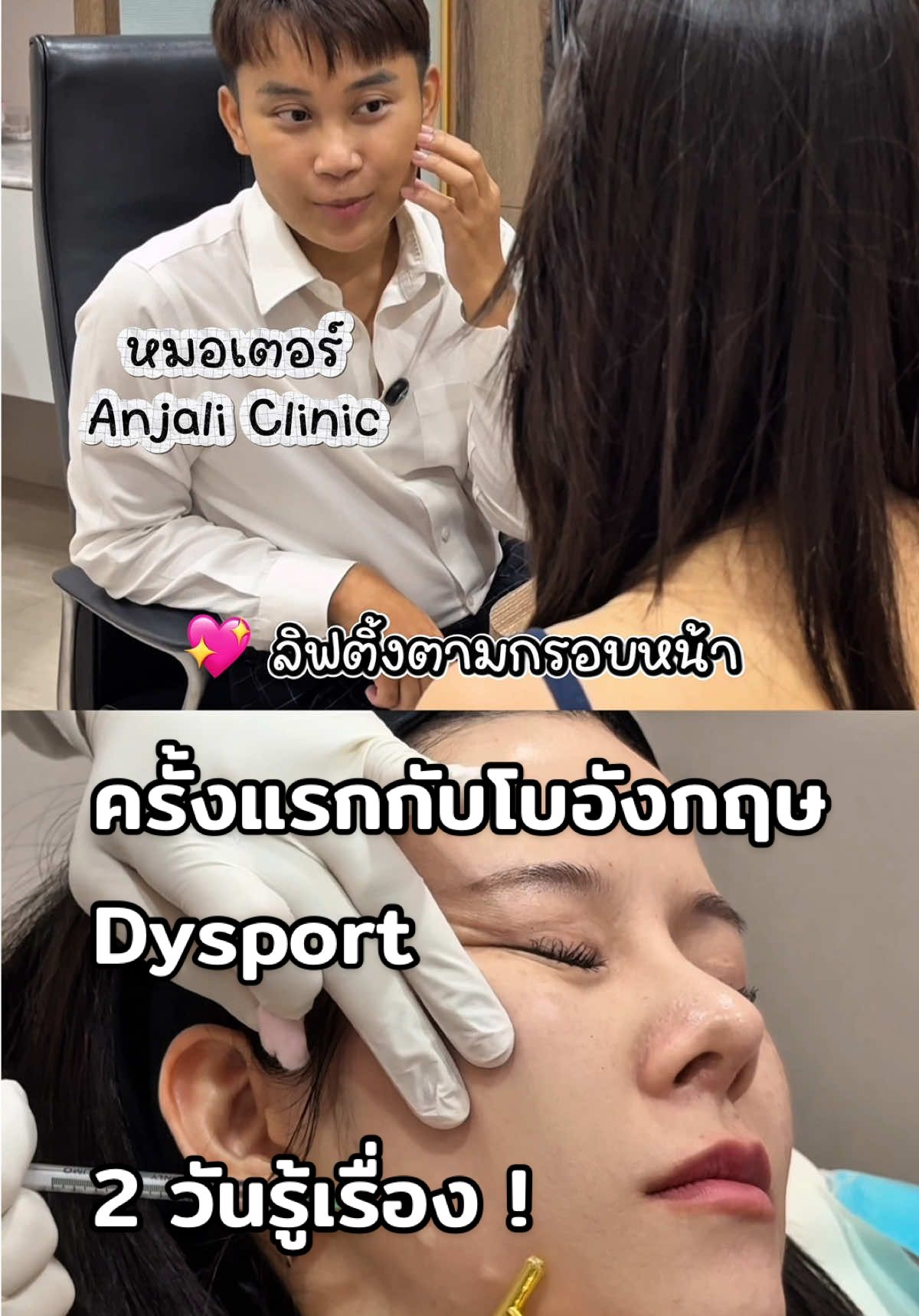 ครั้งแรกของแนนกับโบอังกฤษ Dysport จุดเด่นคือเดิมเกมเร็วมาก 2 วันรู้เรื่องแล้ว นอกจากริ้วรอยทั้งหน้าและคอ หมอเตอร์ยังลิฟหน้าให้ ฉีดลดรูขุมขนหน้าแก้มไปด้วยเลย ทั้งหมดทั้งมวลคือยังแสดงสีหน้าได้ครบ แถมหน้าผากเงาสะท้อนแสง สวยกลมกล่อม💚✨ @แอนจาลี คลินิก  #AnjaliClinic #แอนจาลีคลีนิค #โบท็อกซ์ #Dysport #ฉีดโบ