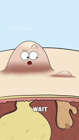 Why Your Pimple Comes Back Bigger After Popping?