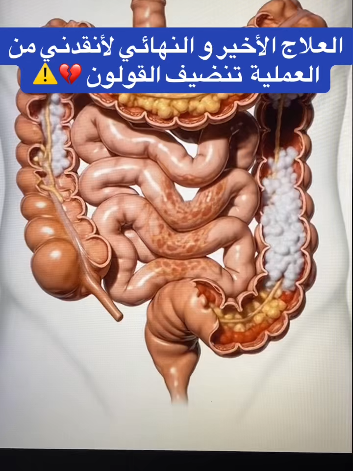 #إنتفاخ_البطن_والأمعاء #إرتجاع_المرئ #إمساك_مزمن #إنتفاخ_القولون #إنتفاخ_البطن #قولون_تقرحي #إمساك #قولون #قولون_معدة_غازات_إنتفاخات_إمساك_حموضة #قولون_هضمي #توعية_صحية #93saudinationalday #الرياض_الان #السعودية_الكويت #خمول #الرياض_الآن🇸🇦🇸🇦 #الرياض_جده_مكه_الدمام_المدينه #مكة_المكرمة_السعودية #الدمام