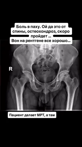 Читать тут🔥 История из практики. Пациента мучают боли в паху. Боль идет от копчика, от спины, от ягодицы, прострелы прямо в пах. Провоцирующие факторы: наклон вперед, это было вначале; приседание; длительная ходьба.  Обращался к терапевту, неврологу. Лечили остеохондроз. Лечили радикулопатию. Отправляли на рентген спины, таза. Тут конечно рентгенологи подкачали((( просмотрели на рентгене (вначале ролика) некроз головки бедренной кости, написали только артроз.  Из-за этой ошибки, пациент еще ходил полгода и не знал свой диагноз, думал что все таки спина… Через какое-то время выполсил МРТ! Основанием стало то, что сустав уже начал клинить. На МРТ некроз головки бедренной кости (стрелка). Обратите внимание на здоровую головку, она с другой стороны.  Пора научится неврологам отличать боль в спине и суставе!  1. Такой сустав часто болит ночью  2. Сустав болит при нагрузке, в покое - нет  3. Очень ранний признак - боль при отведении ноги в сторону и ротации 4. Сустав не даст онемение в ноге, радикулопатия дает 5. «Скрежет» в суставе при пассивном сгибание разгибании, спина такое не даст  6. Утром после отдыха легче! А грыжи в спине, наоборот, болят больше утром после сна.