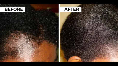 #northernherbz Remedy for extreme hair growth. #fouryou 