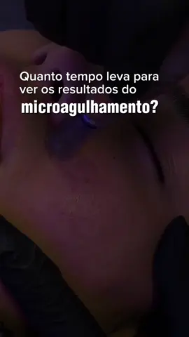 E você, conhece sobre o Microagulhamento ? #fyp #esteticafacial #microagulhamento 