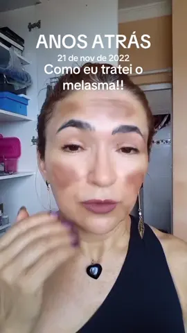 Como eu me livrei do melasma!! #anosatrás 