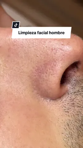 Quien más fan de estrujarle los puntos negros a la pareja?  #blackhead #skincare #limpiezafacialprofunda 