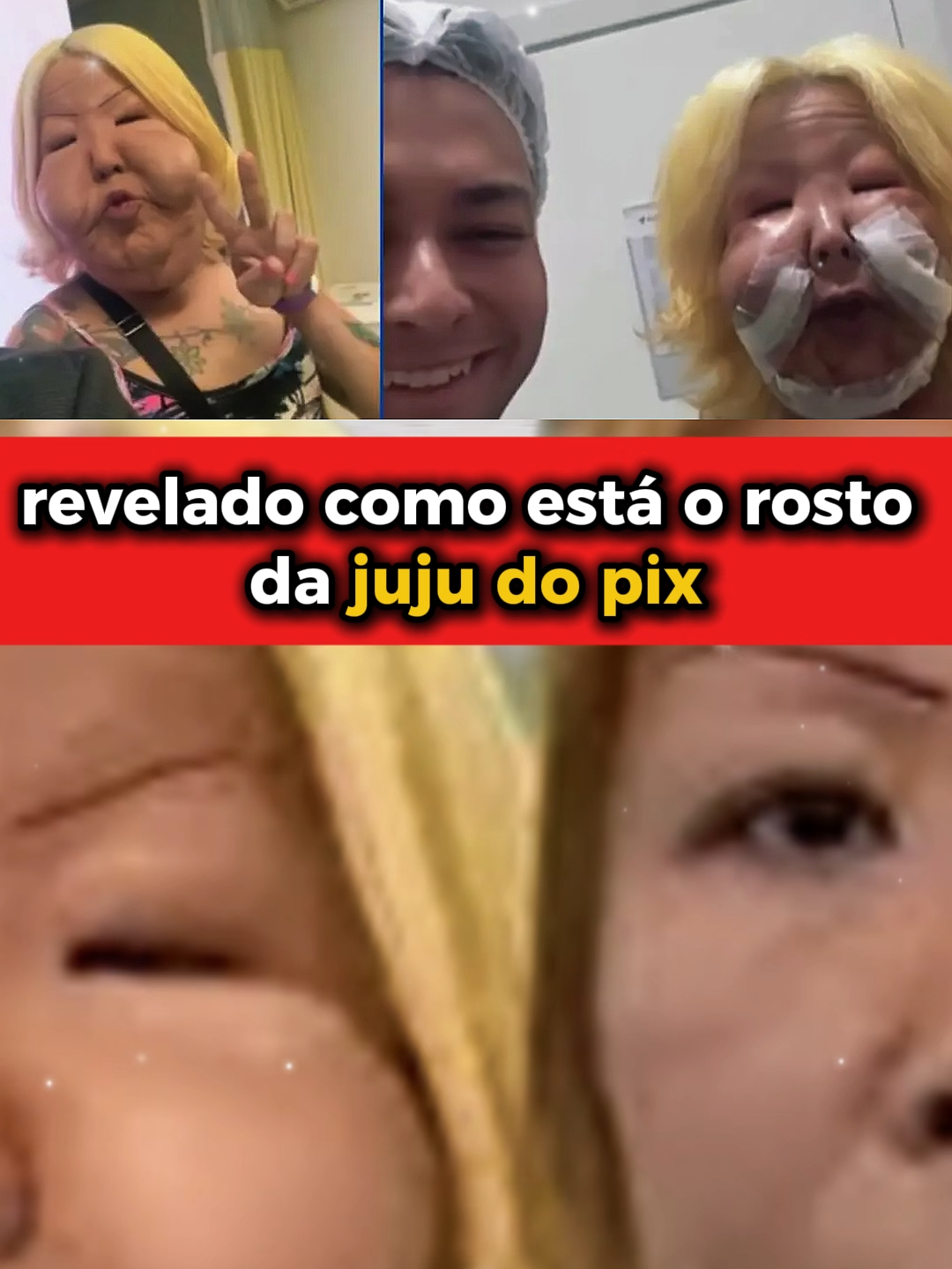 Juju do Pix pós cirurgia | Como ficou o rosto da Juju do Pix | Juju do Pix antes e depois | Juju do Pix antes e depois | Cirurgia da Juju do Pix resultado #jujudopix