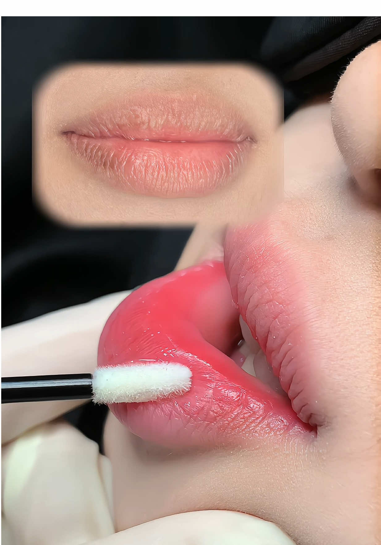 Khử thâm nhấn lòng môi tan viền #phunmoitunhien #phunmoitanvien #phunmoidanang #khuthammoinam #dieukhacchanmay 