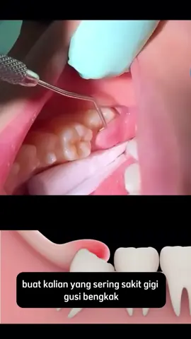 Gigi goyang itu tanda gusi lemah! Tapi masih bisa diperbaiki… #gigiGoyang #gusiLemah #atasiGusi #pastaGigiHerbal #oralHealth