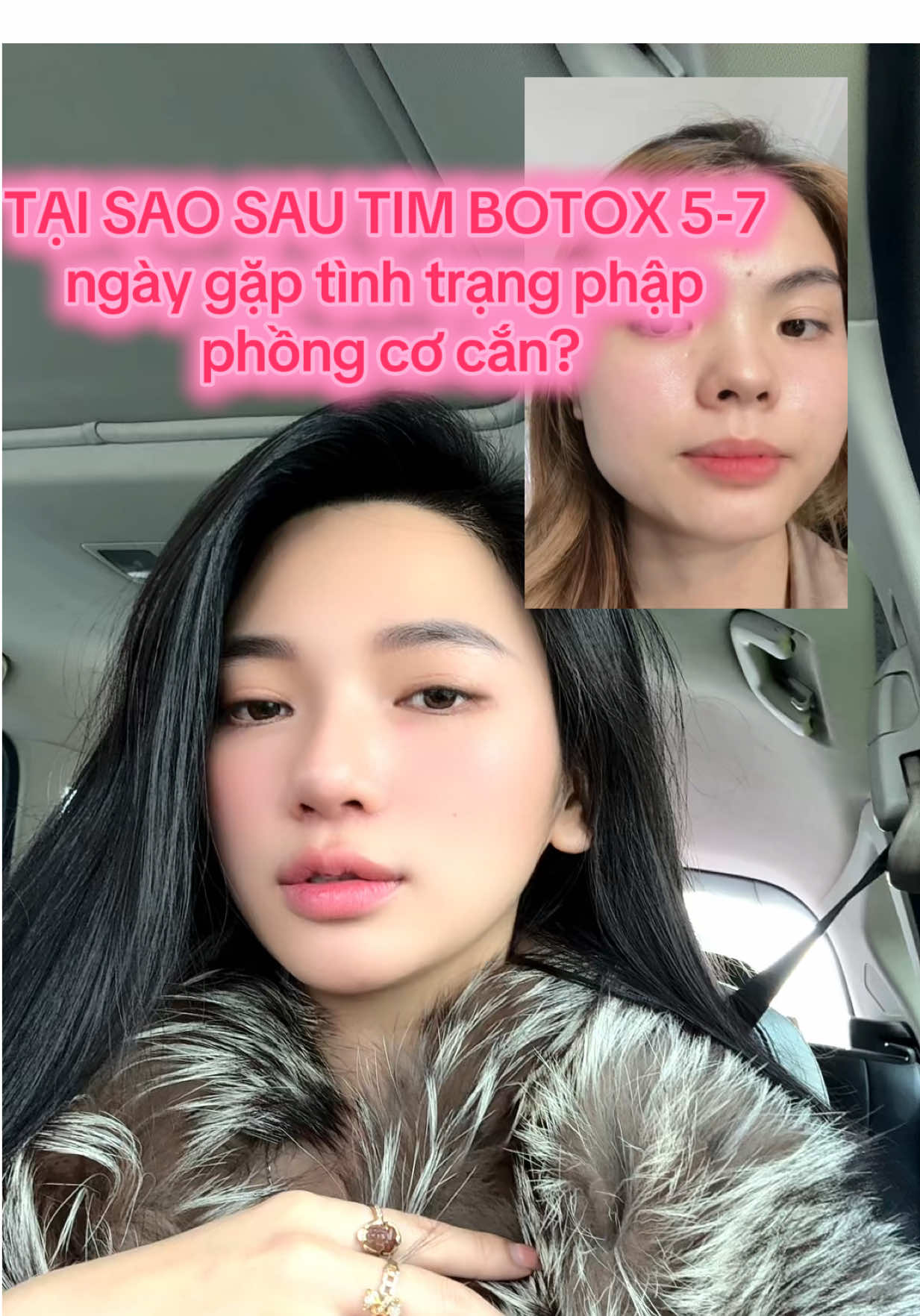 Biến chứng do sai kỹ thuật hay do cấu tạo cơ cắn ban đầu của bạn??? ☺️☺️#depchuanykhoa #DHdebeaute #fillerbotox #canchinhkhuonmat #bienchungbotox @Dung Filler Botox chuẩn y khoa 