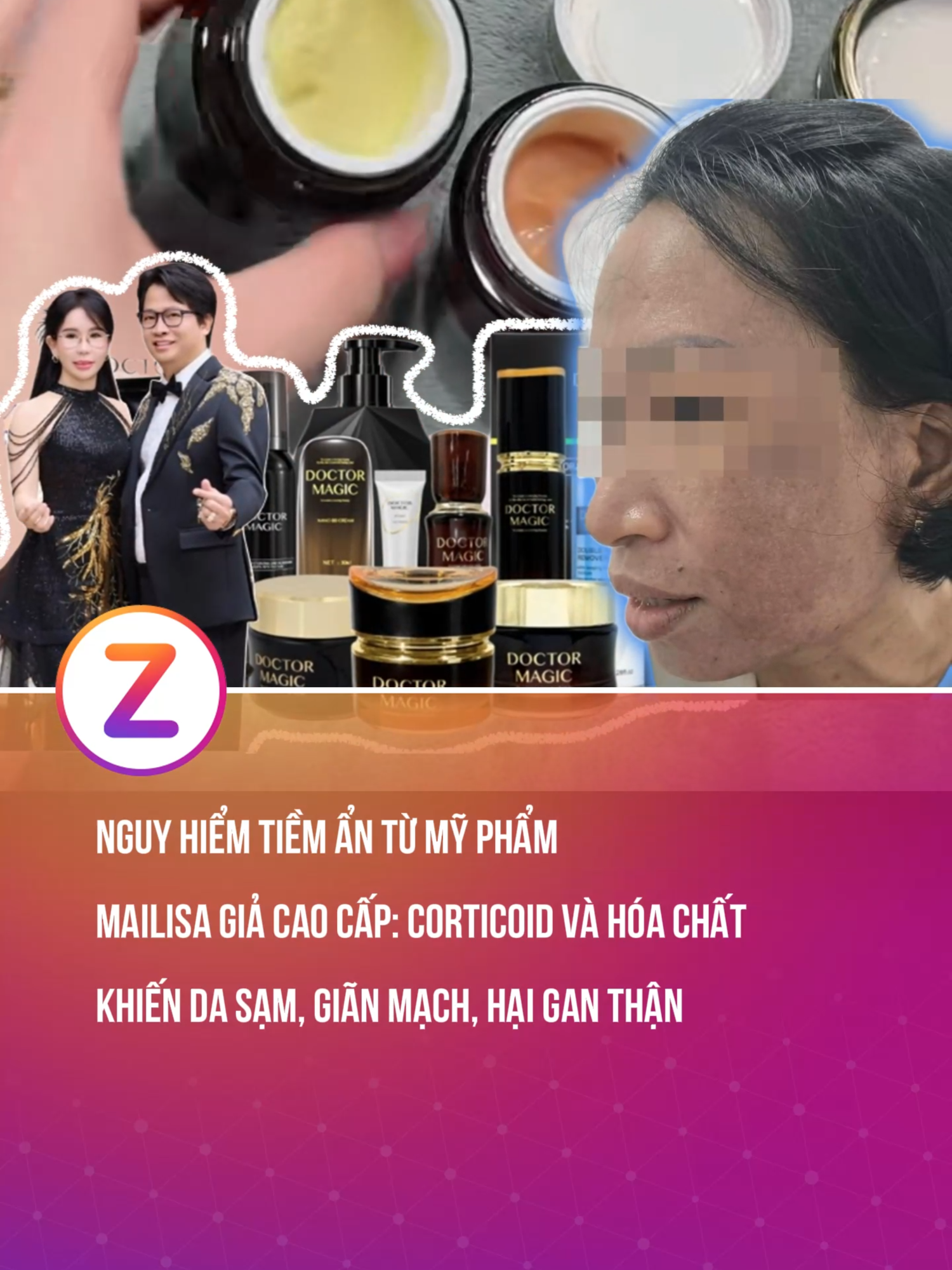 Nguy hiểm tiềm ẩn từ mỹ phẩm Mailisa giả cao cấp: Corticoid và hóa chất khiến da sạm, giãn mạch, hại gan thận #znews #fyp #khampha #mailisa