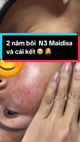 Khách hàng sử dụng bộ N3 sau 2 năm , da dãn mao mạch cuộn cuộn , soi da màn hình đỏ chót , nguy cơ lớn ảnh hưởng sức khoẻ chứ không đơn thuần trên bề mặt da . Với làn da nặng  này khách hàng nên uống giải độc gan ,thanh lọc cơ thể và cai nghiện corti , phục hồi da bằng phương pháp làm dầy thành da + meso ,..... #chuyên_tàn_nhang #phục_hồi_da_nát #xuhuong #Chuyên_Nám 