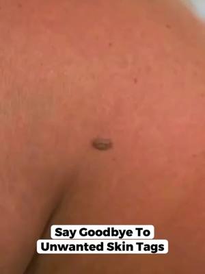 Say goodbye to stubborn skin tags the gentle way Juxek Removal Patch works while you relax