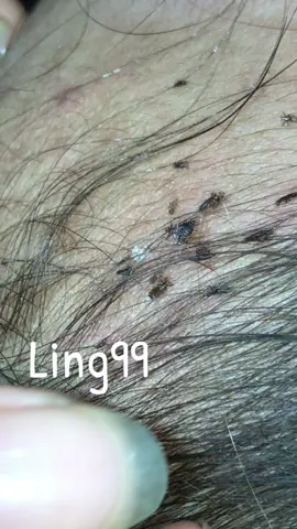 Remove lice #omg😘😘😘😍😍😻😻😽😽🥳🥳😂😂😂 #liceremoval #lice 