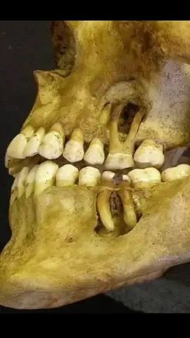 الورم ذوبان العظم التهابات الاسنان دكتوره دينا القيسي#العراق #بغداد #tiktok #الشعب_الصيني_ماله_حل😂😂 #تيكتوك 