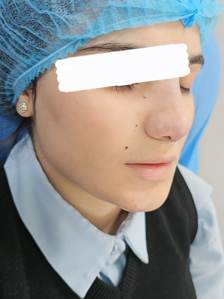 #نتيجة #تجميل #تجميل_الأنف #مجمع_النور_الطبي 