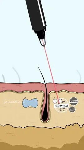How Laser Tattoo Removal Actually Works?