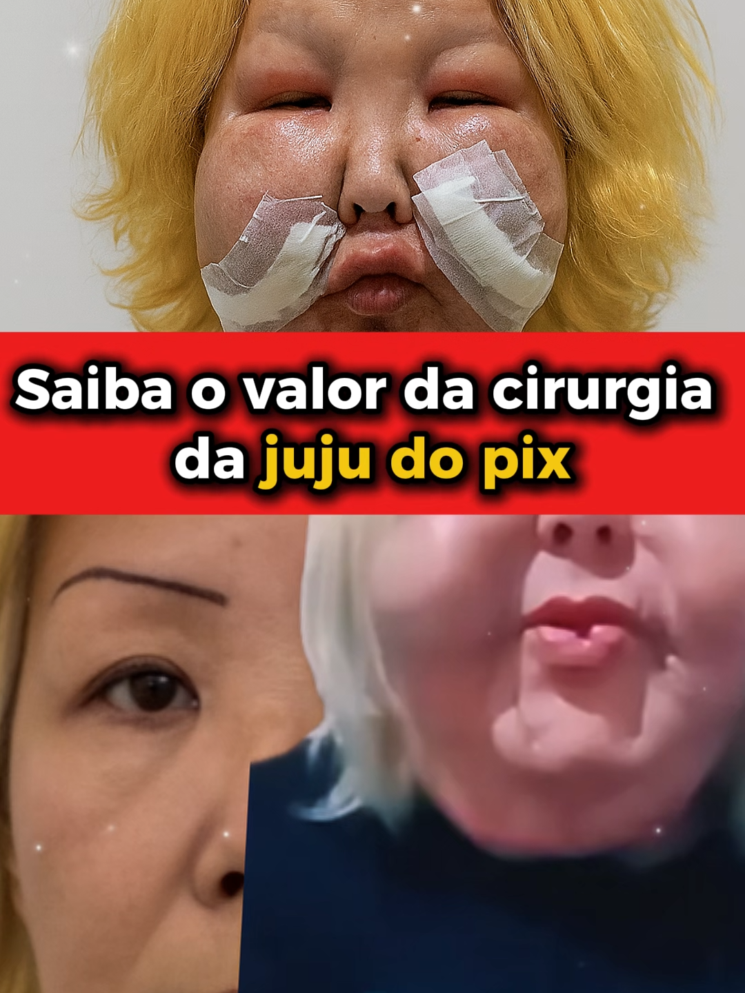 juju do pix cirurgia | juju do pix depois da cirurgia | juju do pix resultado #juju#cirurgia