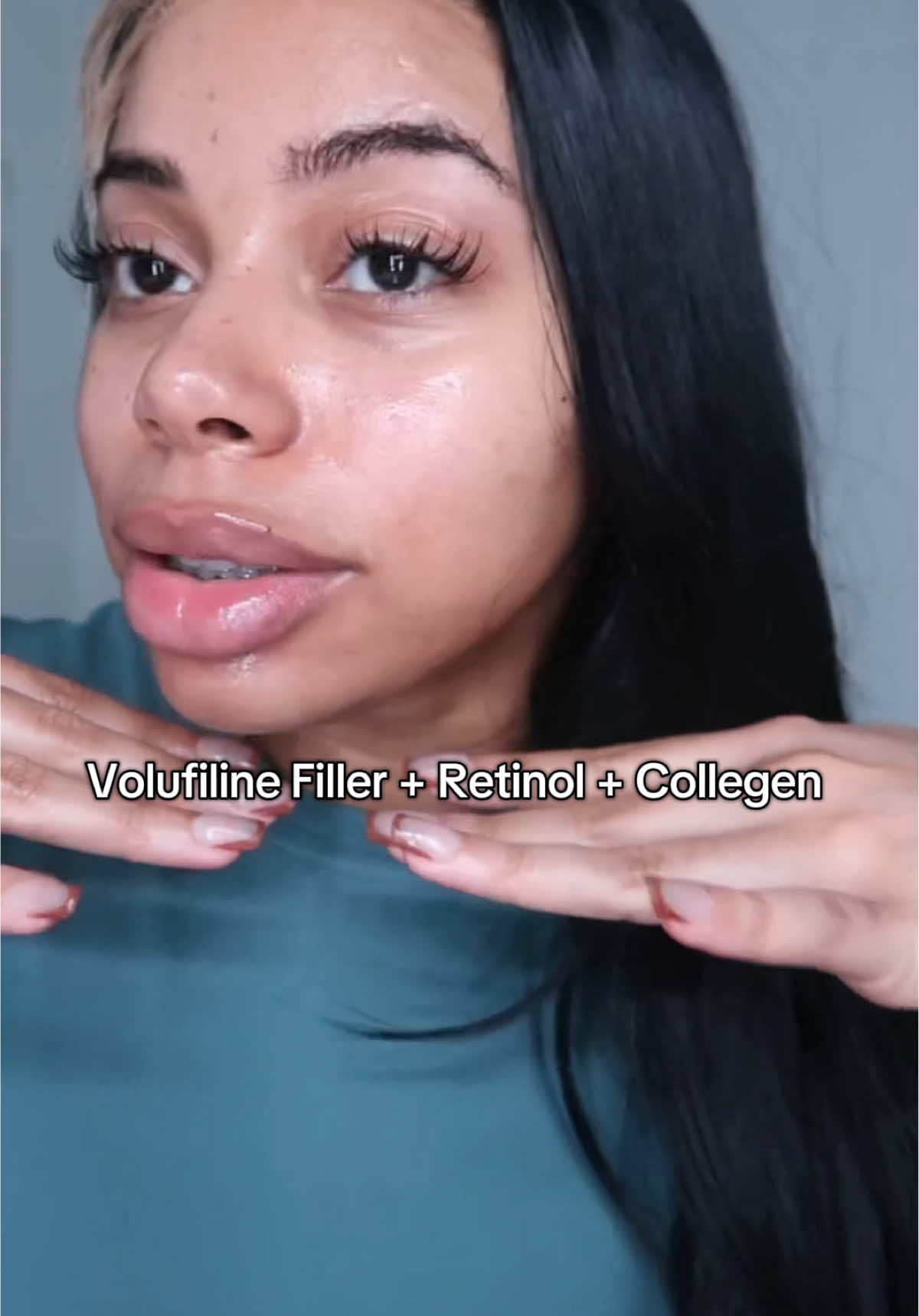 Micro needling and filler in a bottle. Look at the hydration on my face… definitely added to my skin care routine. #sungboon #collegen #retinolserum #plumpskin #blackfridayearlydeals 