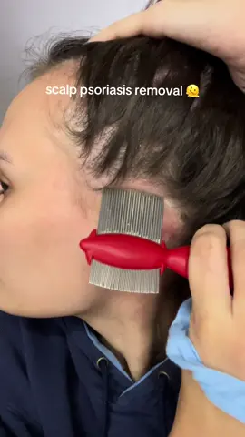 AS LONG AS YOURE MIIIIINE 😩😩😩  #psoriasis #scalppsoriasis #scalppsoriasisremoval #psoriasistok #psoriasisawareness 