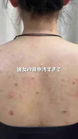彼女の背中汚すぎて萎えるからこれ飲ませた👀 #ニキビ　#スキンケア #サプリ #レチノールcショット #tiktokshop 