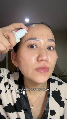 Skin is getting bettet! @KSECRET GLOBAL  #glowshotchallenge #ksecret #seoul1988 #hyperpigmentation #darkspots 