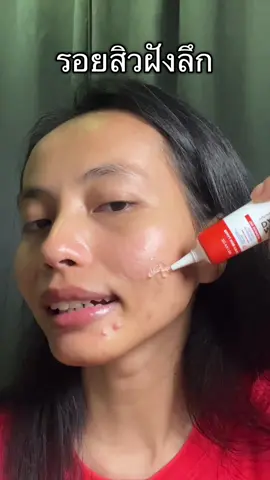 #เจลแต้มรอยสิว  #เจลมานูก้า  #เจลแต้มรอยมานูก้า  #รอยสิว  #รอยดําจากสิว 