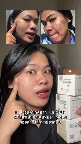 เจอตัวนี้แบบบังเอิญ แต่พอใช้แล้วแบบเห้ยย บางหัวหลุดเอง สะกิดหลุด กดง่ายขึ้น ไม่ทิ้งรอยเลย #สบู่เซรั่มสด #สิวอุดตัน 