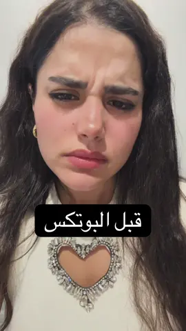 احلا اجراء تجميلي هو البوتكس      #viral #ruba_skincare #botox 