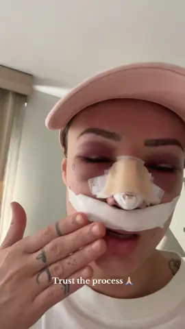 Can’t believe I looked like that!! Such a crazy healing journey but so worth the results! 🥰🥰 Looking forward to when it’s fully healed in a year 🥺 #rhinoplasty #turkey #nosejob #postop #surgery 