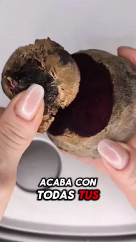 “Remedio casero para aliviar el aspecto de tus várices naturalmente” #Varices #PiernasSanas #RemediosCaseros #SaludNatural #CuidadoPersonal