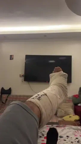 #fyppppppppppppppppppppppp #brokenankle #fracture #crutches #anklesurgey 