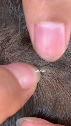 😱😱#omg #lice #liceremoval 