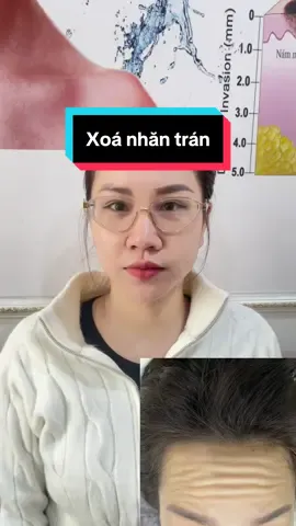 Xoá nhắn trán, cau mày giúp các cơ được thư giãn, k hình thành vết nhăn tĩnh. Bà nào hay cáu chồng thì nen tiêm nha #tiemfillerhanoi #lamdep #tiemfiiler #fillerbotox #botoxgonham 