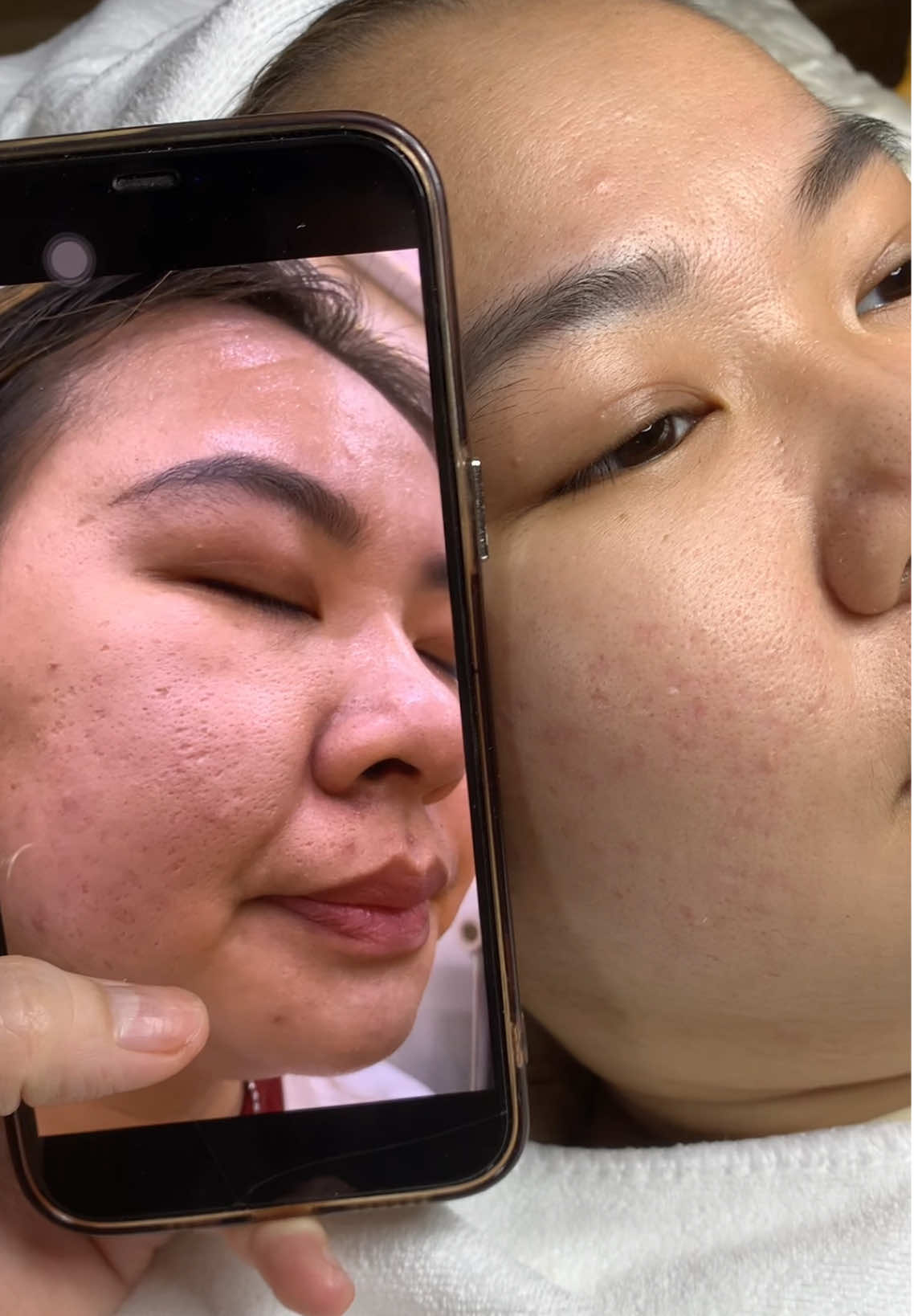 Cập nhật da Sẹo#chamsocdamun#chamsocdaseo#chamsocdanam#tanbinh#Lqspa&academy