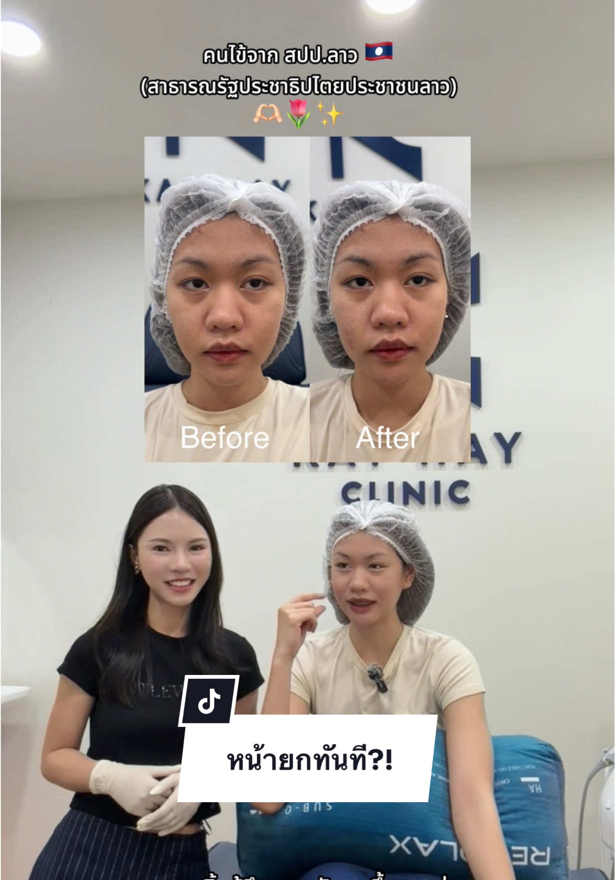 กระชับใบหน้าทุกชั้นผิวด้วยโปรแกรมเครื่องยกกระชับ ultraformer 🌷✨ Kay Hay Clinic สาขาอุดรเปิดแล้ว ไว้มาให้แบมดูแลนะคะ ☺️💕✨ @K@KAY HAY clinicพ@พี่หมอแบม #ปรับรูปหน้า #รีวิวอุดร #หน้าเรียว #เครื่องยกกระชับ #คลินิกเสริมความงาม