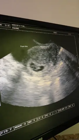 my not so little bean now 🥹 #pregnancytiktok #babyultrasound #babytiktok #firsttimemom 