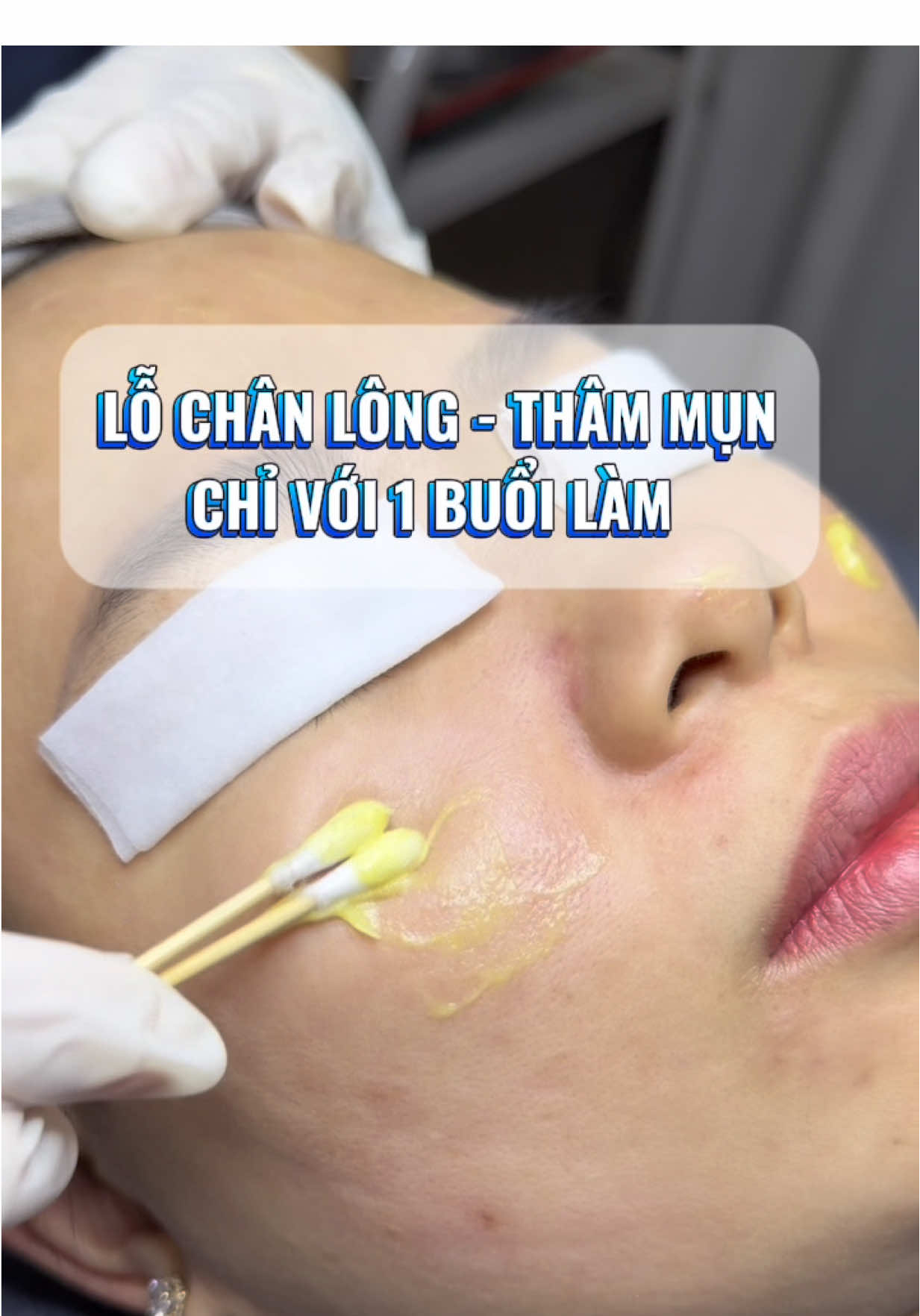 Da dày sừng , không đều màu , mụn nhẹ => nên peel nhé chị em ❤️❤️#govap #peelda #lochanlongto 